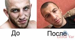 Джабару Аскерову исправили нос (Фото)